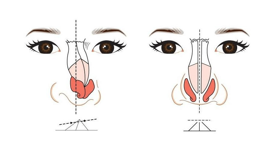 歪鼻矫正 歪鼻矫正