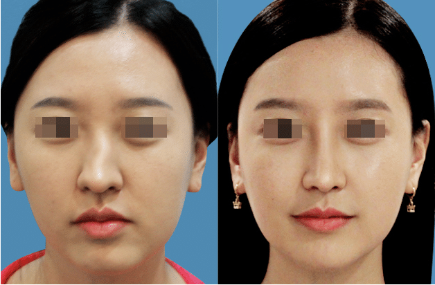 歪鼻矫正 歪鼻矫正