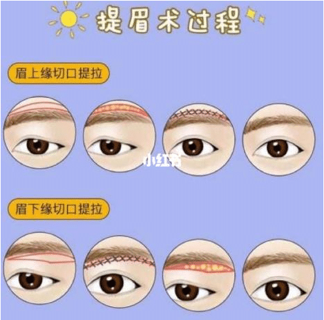 切眉手术的原理是什么?切眉手术能解决什么问题?