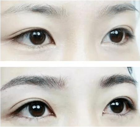 眉毛移植 眉毛移植