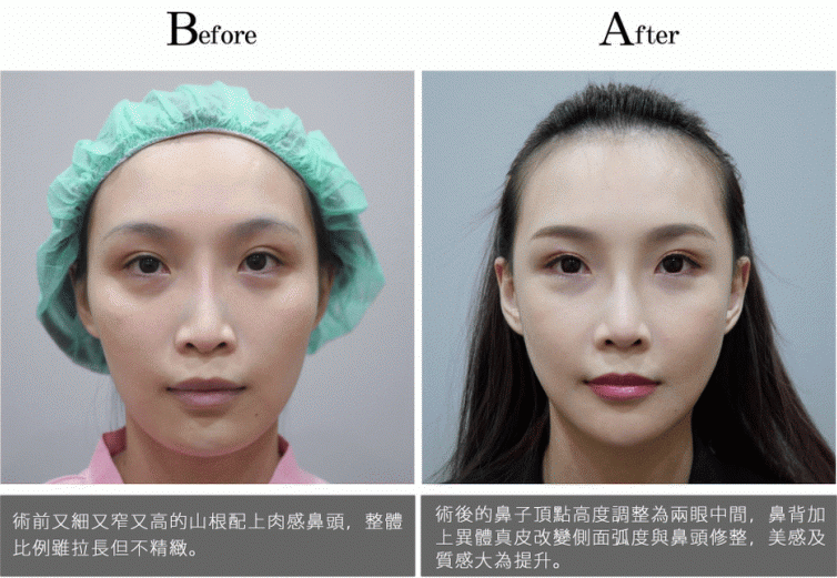 隆鼻术后怎么护理恢复快?