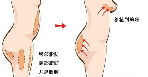 自体脂肪隆胸效果怎么样?存活率高不高