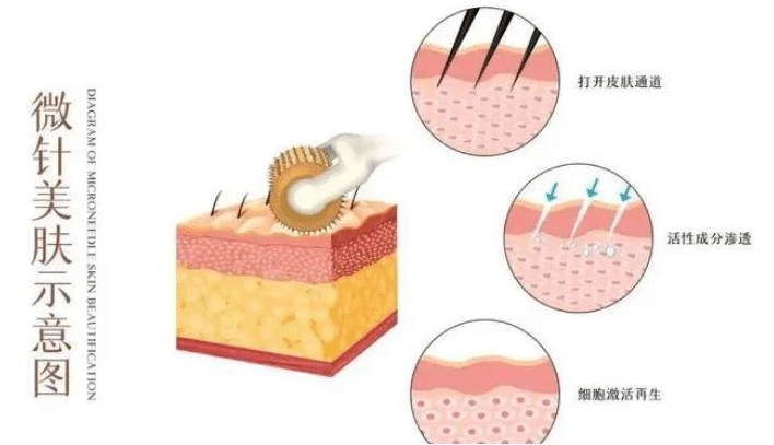 微针祛痘印的原理是什么,有什么优势