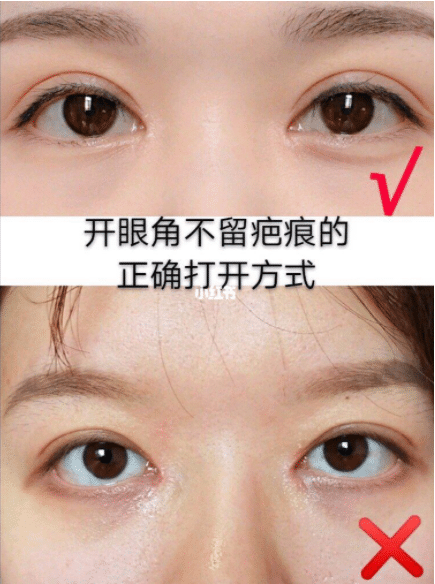 开眼角拆线后洗脸需要注意什么,开眼角术后怎么护理?