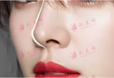 隆鼻排斥会出现哪些症状,隆鼻适合哪些人群?