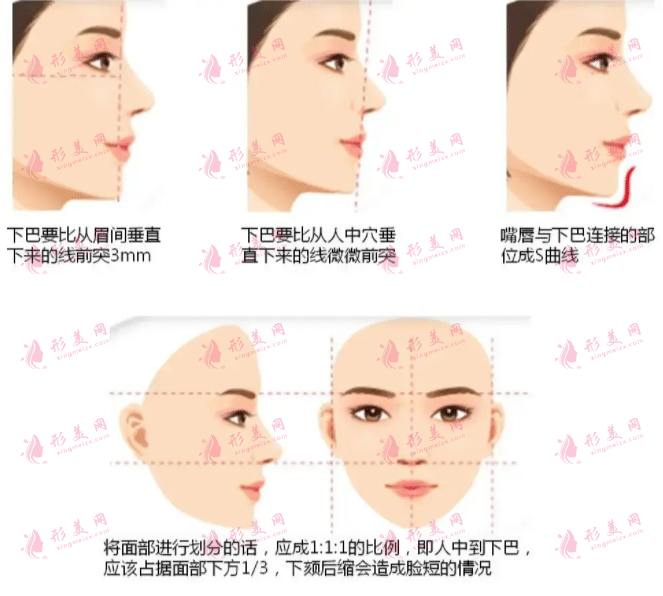 垫下巴后正常笑要多久?多久能完全恢复?