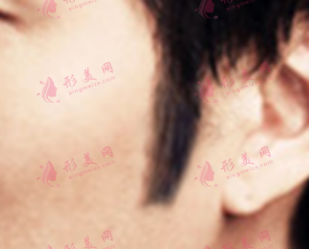 厦门雍禾植发医院鬓角种植效果好吗 安全性怎样 厦门雍禾植发医院鬓角种植效果好吗 安全性怎样