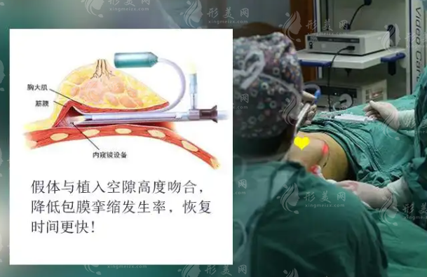 内窥镜假体丰胸多少钱?项目有危害吗?