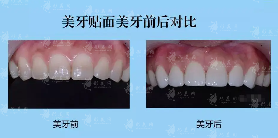 做牙齿贴面的时间长不长? 做牙齿贴面的时间长不长?