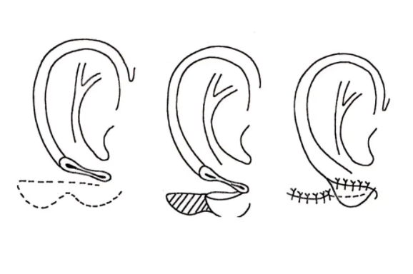 耳朵整形医院有耳朵畸形国家有补助? 耳朵整形医院有耳朵畸形国家有补助?