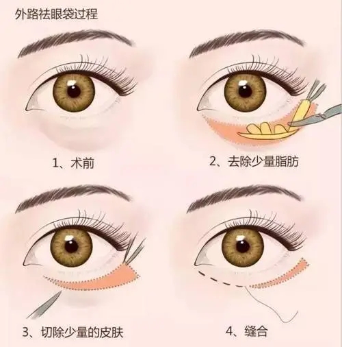 做双眼皮后眼睛肿了怎么办?如何使用疤克?