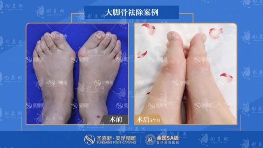 大脚骨手术苏敬达怎么样?北京圣嘉新微创技术轻松摆脱大脚骨 大脚骨手术苏敬达怎么样?北京圣嘉新微创技术轻松摆脱大脚骨