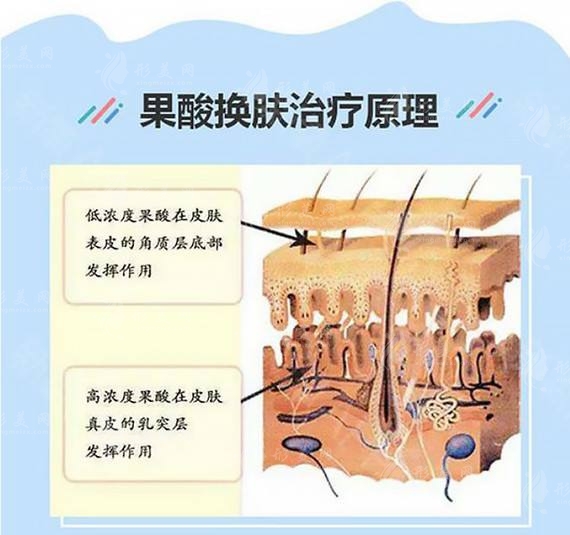 果酸换肤原理 果酸换肤原理