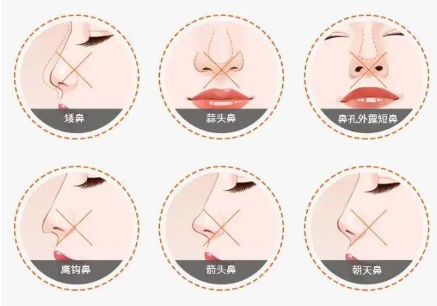 隆鼻需要多长时间,如何预防隆鼻引起的鼻子发红?