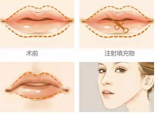 自体脂肪丰唇需要多长时间恢复,优势是什么