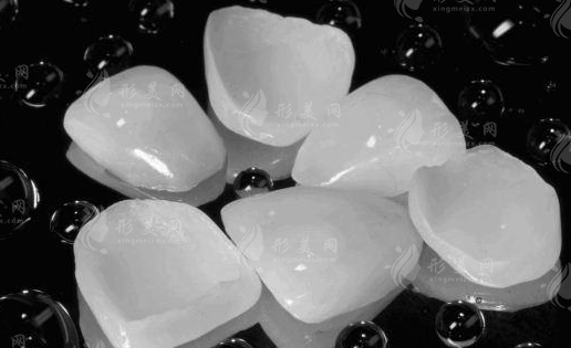 牙齿贴面的费用贵不贵呀? 牙齿贴面的费用贵不贵呀?