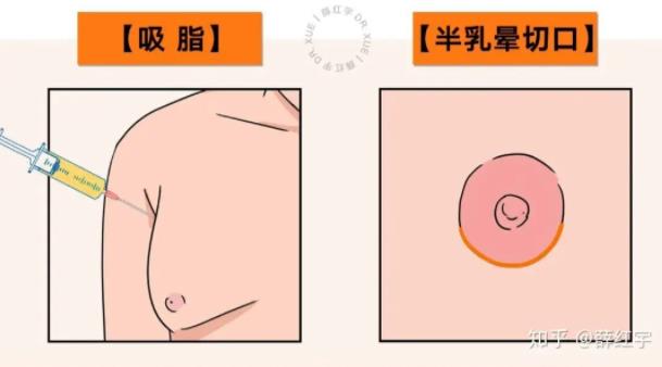乳房缩小手术是怎么做的?手术的详细步骤
