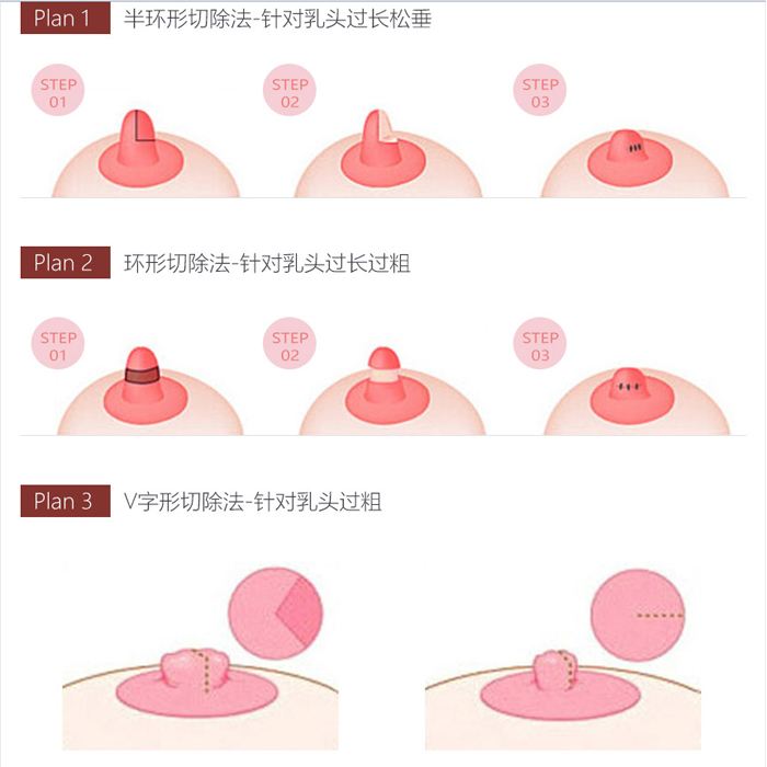 乳头缩小会影响母乳喂养吗?乳头缩小手术的特点是什么?