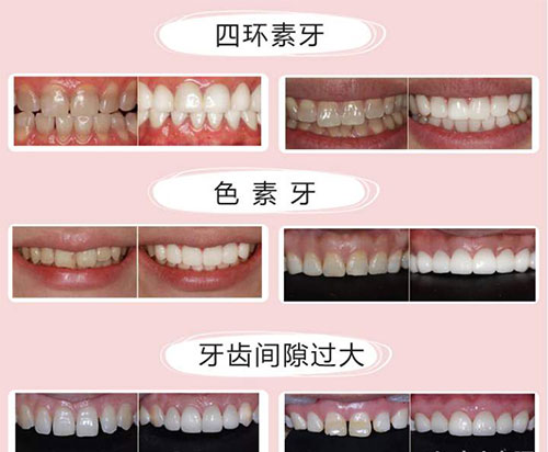 牙齿美白的示意图 牙齿美白的示意图