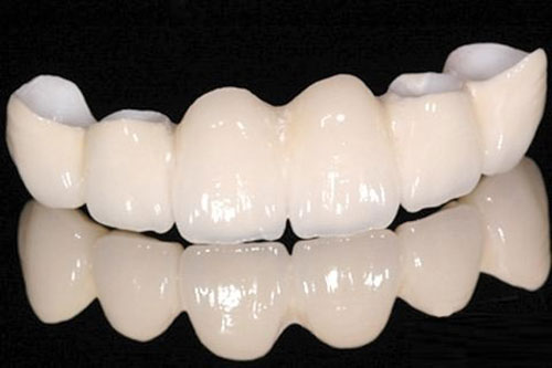 烤瓷牙示意图 烤瓷牙示意图