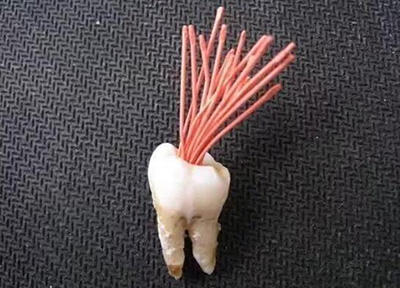 根管治疗照片 根管治疗照片