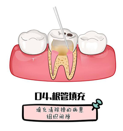 根管治疗卡通照片 根管治疗卡通照片