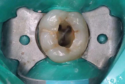 根管治疗后必须做牙套吗 根管治疗后必须做牙套吗