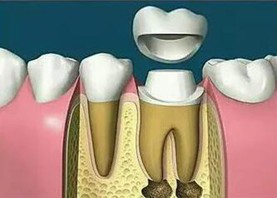 根管治疗卡通修复过程 根管治疗卡通修复过程