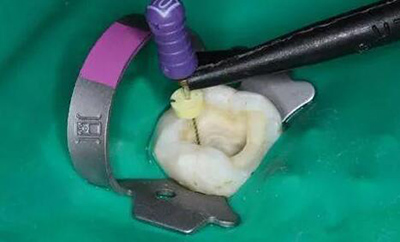 根管治疗千万不要做牙冠 根管治疗千万不要做牙冠