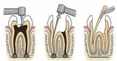根管治疗卡通照片 根管治疗卡通照片