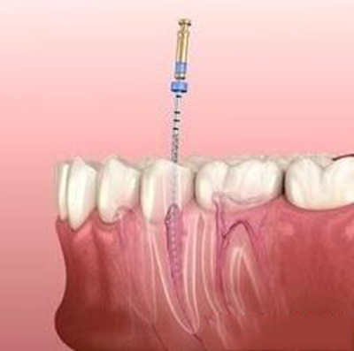 根管治疗卡通图 根管治疗卡通图