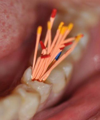 根管治疗后必须做牙套吗 根管治疗后必须做牙套吗
