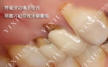 做牙冠修复出现不适感 做牙冠修复出现不适感