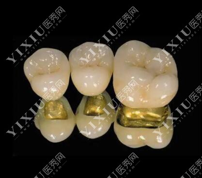 牙冠材料展示图 牙冠材料展示图