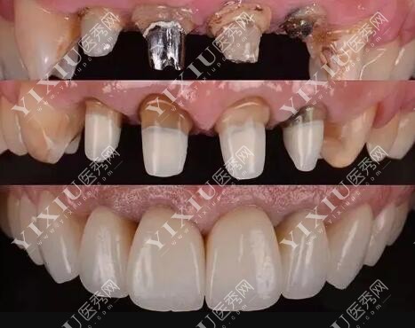 牙冠修复展示前后对比 牙冠修复展示前后对比