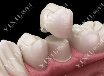 牙冠修复改善展示照片 牙冠修复改善展示照片