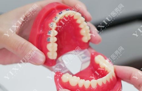牙齿矫正模型图 牙齿矫正模型图