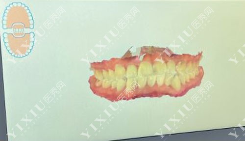 牙齿矫正术前方案设计 牙齿矫正术前方案设计