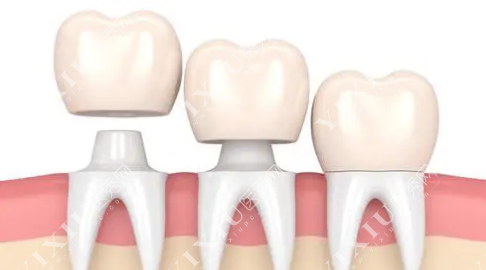 牙冠模型卡通示意图 牙冠模型卡通示意图