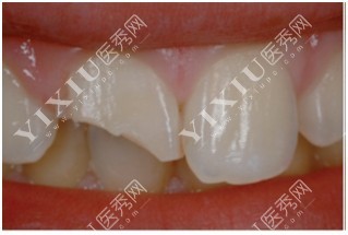 门牙牙冠断裂示意图 门牙牙冠断裂示意图