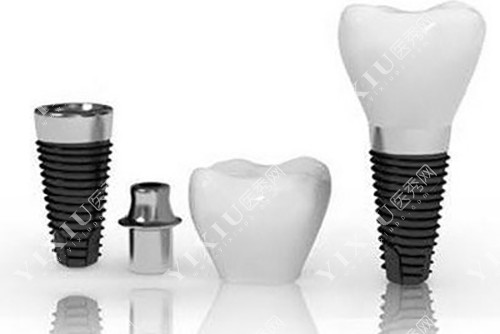 种植牙基台植体牙冠结构示意图 种植牙基台植体牙冠结构示意图