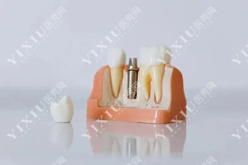 种植牙和真牙对比模型示意图 种植牙和真牙对比模型示意图