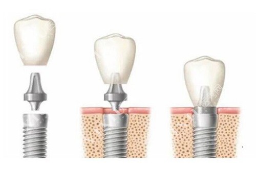 种植牙简易过程示意图 种植牙简易过程示意图