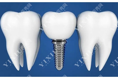 种植牙和真牙对比模型示意图 种植牙和真牙对比模型示意图