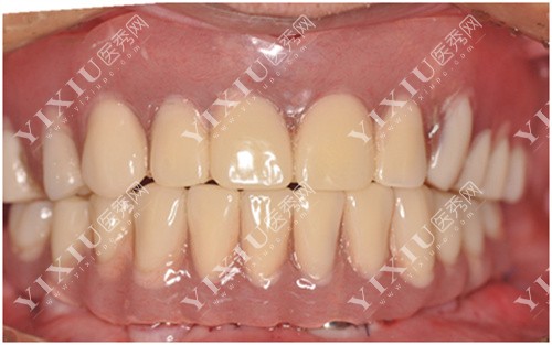 牙齿咬模图 牙齿咬模图