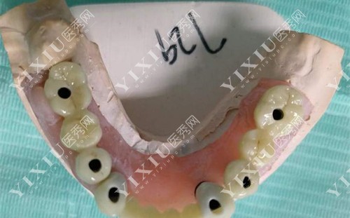 牙齿模具图 牙齿模具图