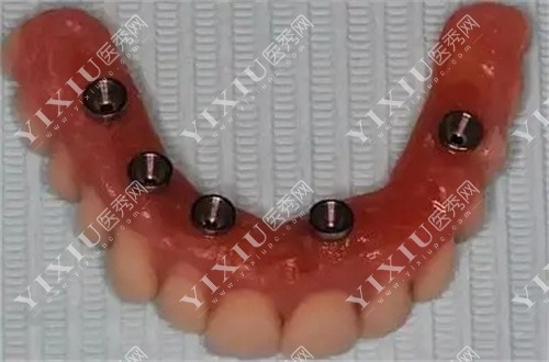 种植牙齿模具图 种植牙齿模具图