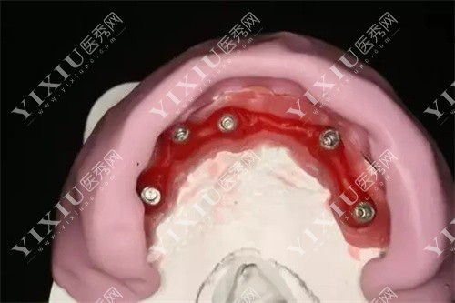 牙齿模型覆盖图 牙齿模型覆盖图