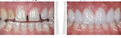 牙齿贴面前后对比示意图
