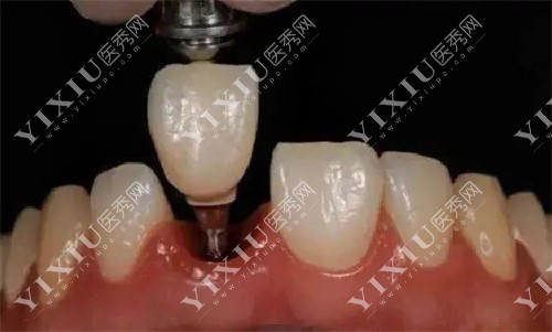 牙齿植入图 牙齿植入图